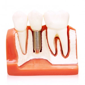implant-dentures