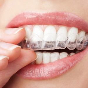 teeth whitening